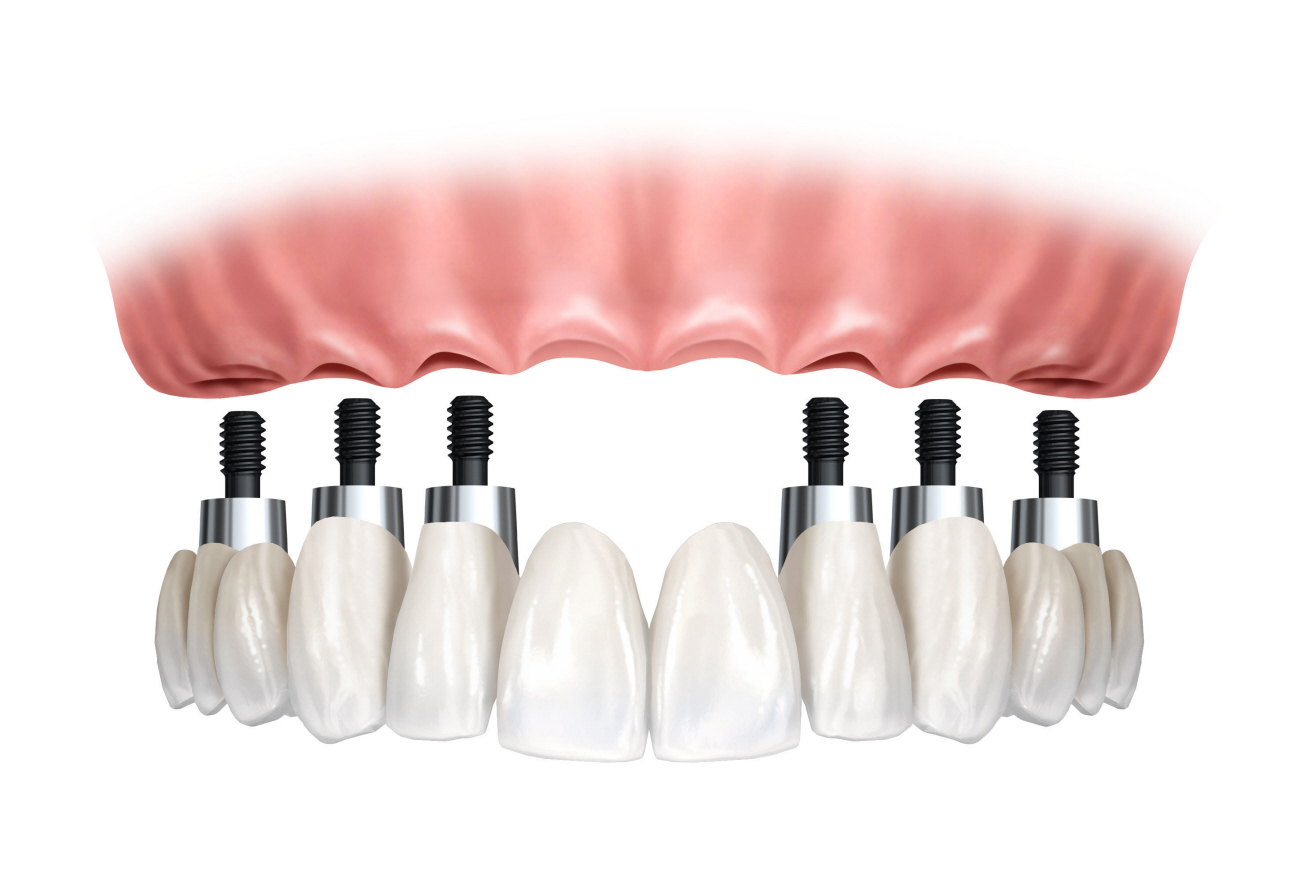 Leia mais sobre o artigo Associação Brasileira de Odontologia oferece implantes subsidiados
