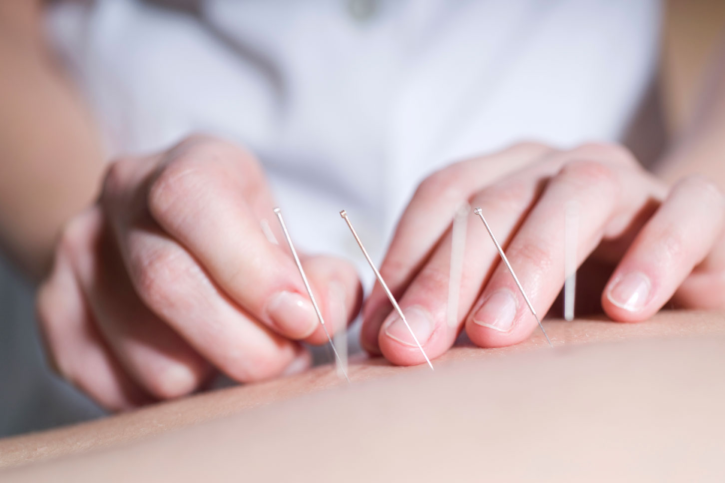 Leia mais sobre o artigo Eficácia da acupuntura é comprovada pelo Hospital das Clínicas